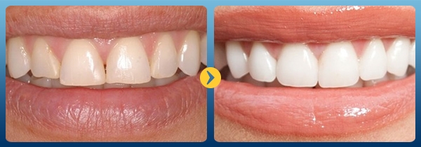 Trước và sau khi làm trắng răng bằng baking soda